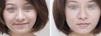 水润祛痘 恢复光滑细嫩的肌肤