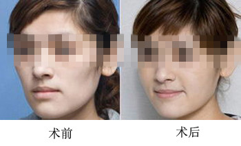 自体脂肪丰面颊快速多少合适