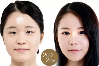艺星艺星艺星美杜莎眼睛增大术