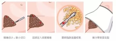 吸脂瘦身