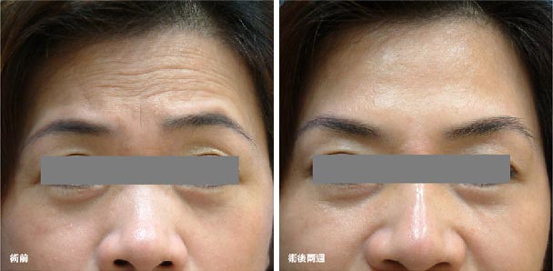 如何快速去除抬头纹？
