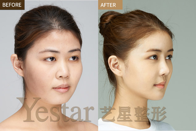 艺星割双眼皮前后对比图
