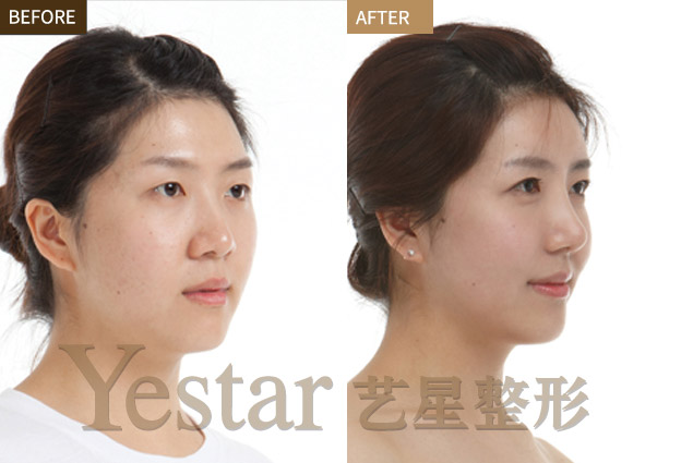 割双眼皮前后对比图