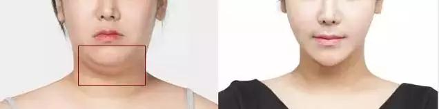 超声理疗仪