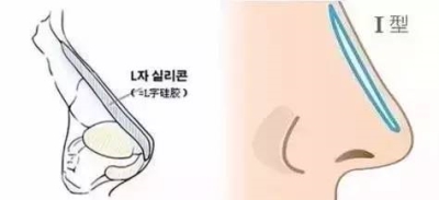 隆鼻后能不能揉呢-艺星隆鼻为您介绍