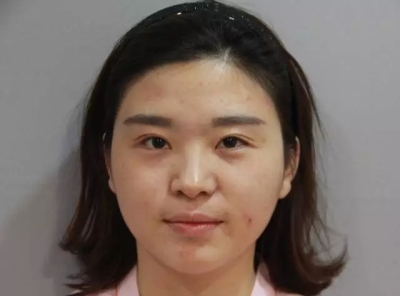 隆鼻后能不能揉呢-艺星隆鼻为您介绍