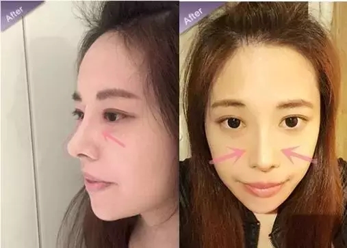 隆鼻后能不能揉呢-艺星隆鼻为您介绍