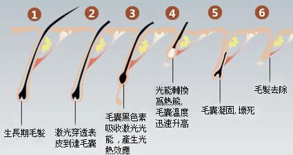 冰点脱毛
