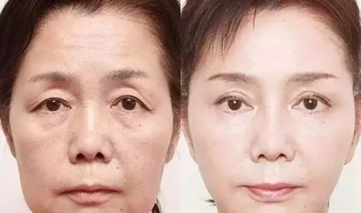 动态形眼角纹