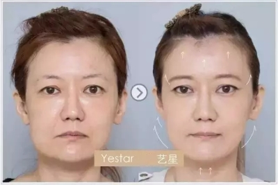 超声理疗仪除皱前后对比图