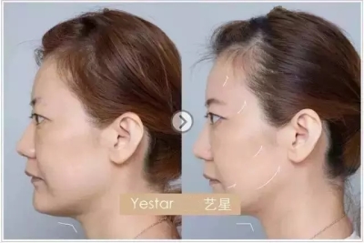 超声理疗仪除皱前后对比图