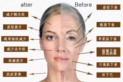 超声理疗仪除皱前后对比图