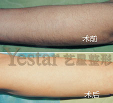 冰点激光脱毛前后对比图