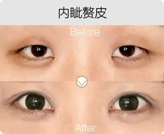艺星艺星艺星艺星美杜莎综合美眼前后对比图