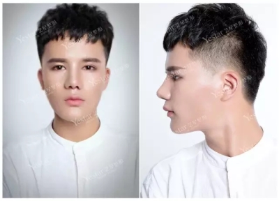 隆鼻前后对比图