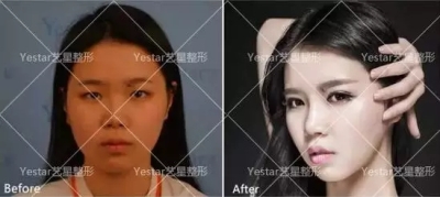艺星艺星艺星艺星美杜莎综合美眼前后对比图