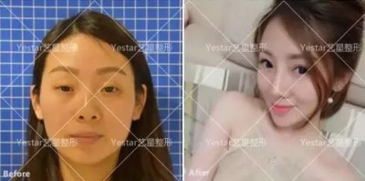 艺星艺星艺星艺星美杜莎综合美眼前后对比图