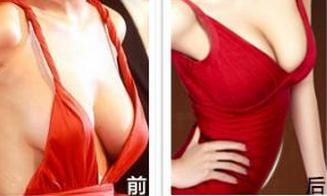 乳房下垂矫正多少钱