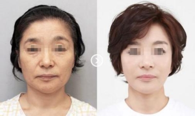 电波拉皮除皱，“拉”回多年前的容颜和好身材