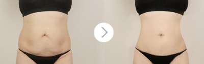 腰腹吸脂