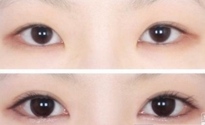 北京做双眼皮多少钱？超强攻略一秒变大眼