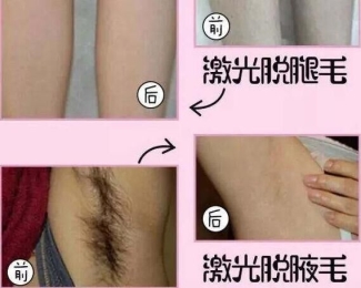 【美丽秘籍】要脱单先脱毛，春季脱毛正当时