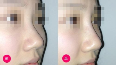 解答：玻尿酸隆鼻效果好不好